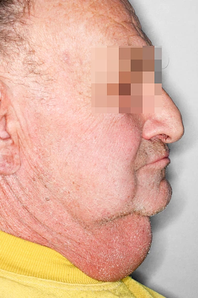 Beispiele: Schwellung durch Lymphstau