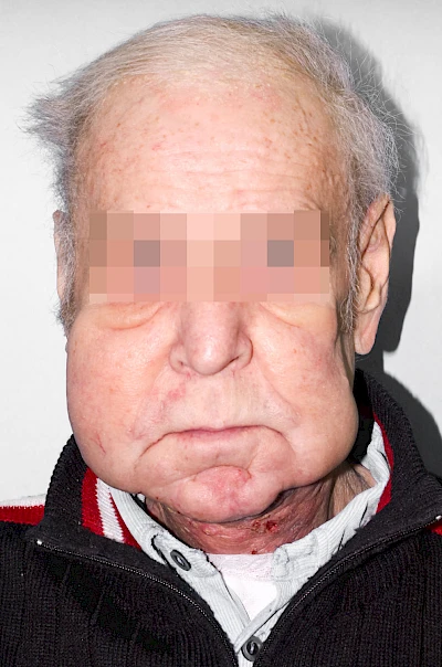 Beispiele: Schwellung durch Lymphstau