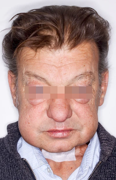 Beispiele: Schwellung durch Lymphstau