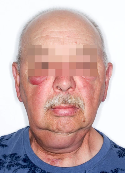 Beispiele: Schwellung durch Lymphstau