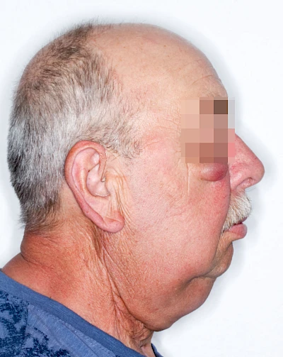 Beispiele: Schwellung durch Lymphstau