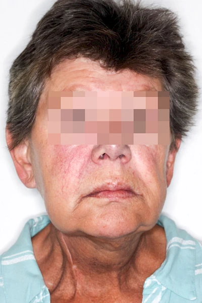 Beispiele: Schwellung durch Lymphstau
