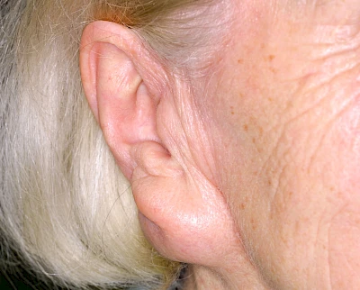 Beispiele: Schwellung durch Tumor