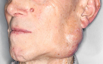 Beispiele: Schwellung durch Tumor