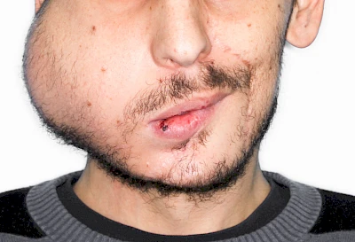 Beispiele: Schwellung durch Tumor
