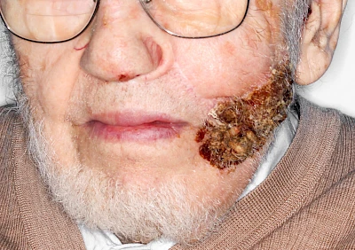 Beispiele: Schwellung durch Tumor