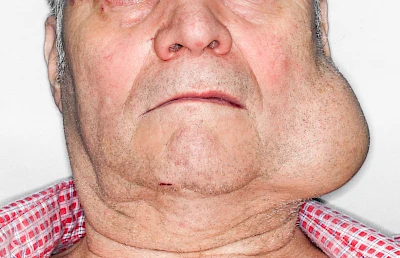 Beispiele: Schwellung durch Tumor