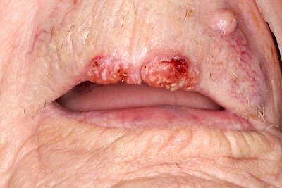Beispiele: Schwellung durch Tumor