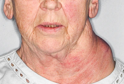 Beispiele: Schwellung durch Tumor