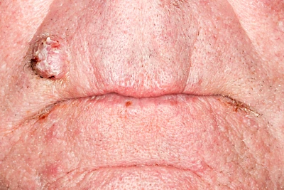 Beispiele: Schwellung durch Tumor