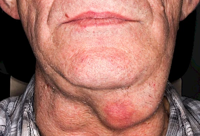Beispiele: Schwellung durch Tumor