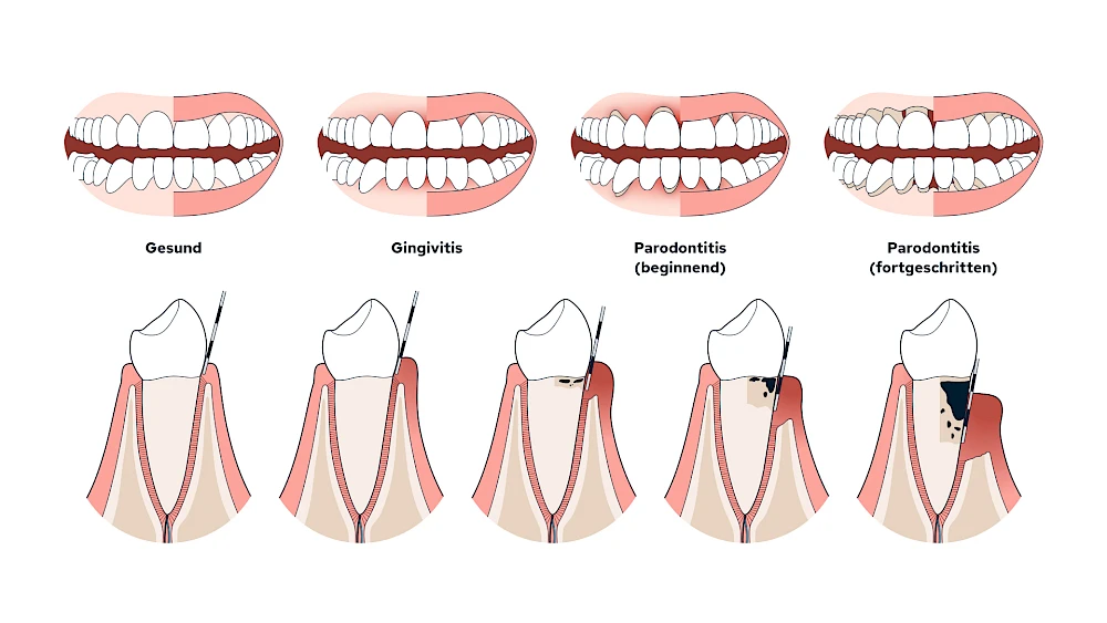 Gingivitis & Parodontitis: Stadien