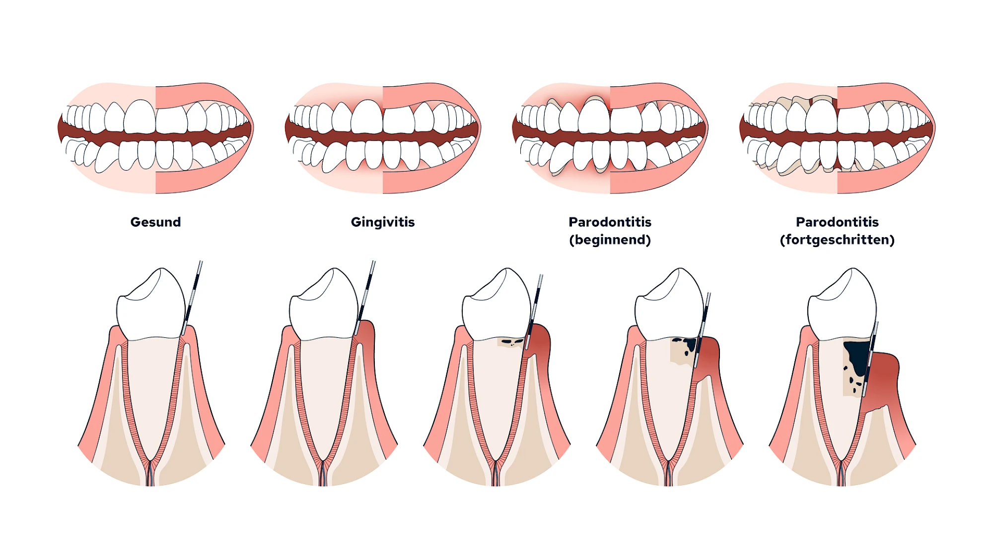 Gingivitis & Parodontitis: Stadien