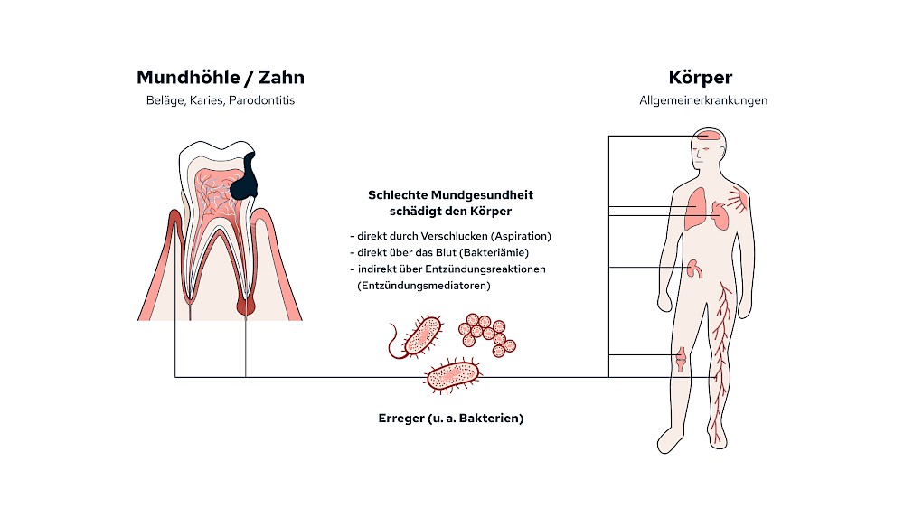 Zusammenhänge von Erkrankungen der Mundhöhle bzw. der Zähne und Allgemeinerkrankungen