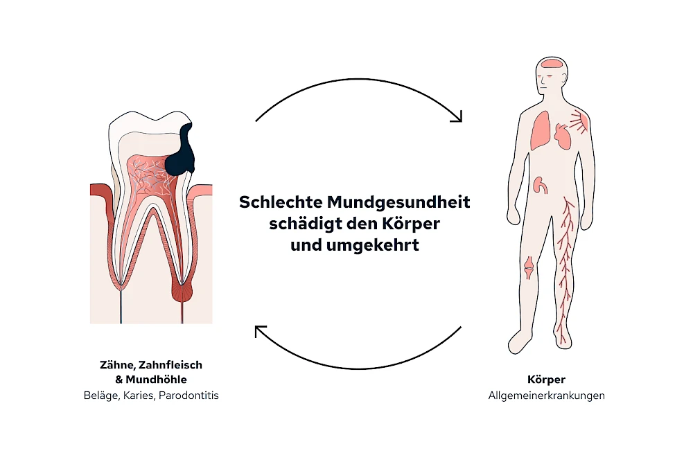 Zusammenhänge von Parodontitis und Allgemeinerkrankungen