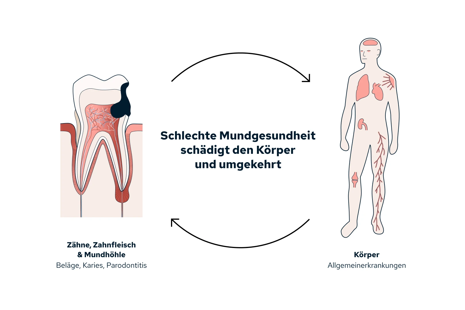 Zusammenhänge von Parodontitis und Allgemeinerkrankungen