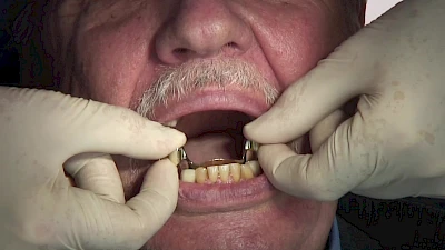 Beispiele: Aus- & Eingliederung von Zahnprothesen