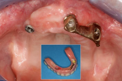 Beispiele: Zahnimplantat