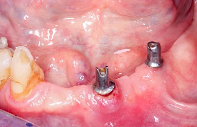 Beispiele: Zahnimplantat