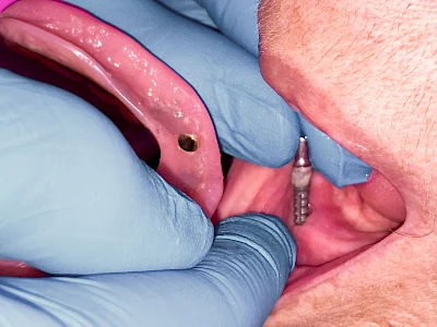 Beispiele: Zahnimplantat