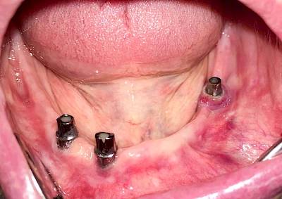Beispiele: Zahnimplantat