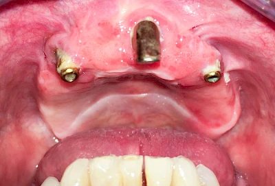 Beispiele: Zahnimplantat