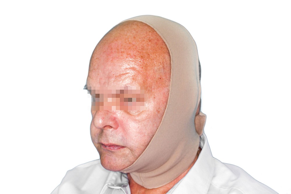 Operation, Chemo- & Strahlentherapie Bestrahlung: Lymphstau Kopf-Kinn-Bandage bei Lymphstau
