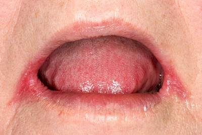 Lippen & Mundwinkel Beispiele 