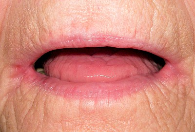 Lippen & Mundwinkel Beispiele 