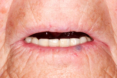 Beispiele: Bluterguss