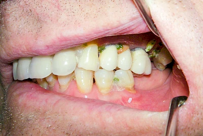 Beispiele: Speisereste