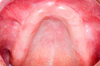 Beispiele: Schlotterkamm