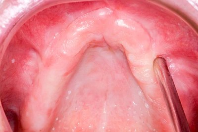 Beispiele: Schlotterkamm