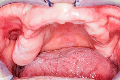 Beispiele: Schlotterkamm