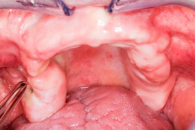 Beispiele: Schlotterkamm