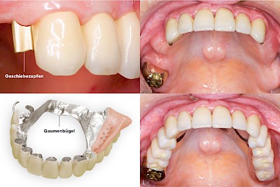 Zahnprothese Verbindungselemente Teilprothese: Geschiebeprothese