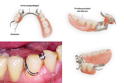 Zahnprothese Verbindungselemente Teilprothese: Klammerprothese