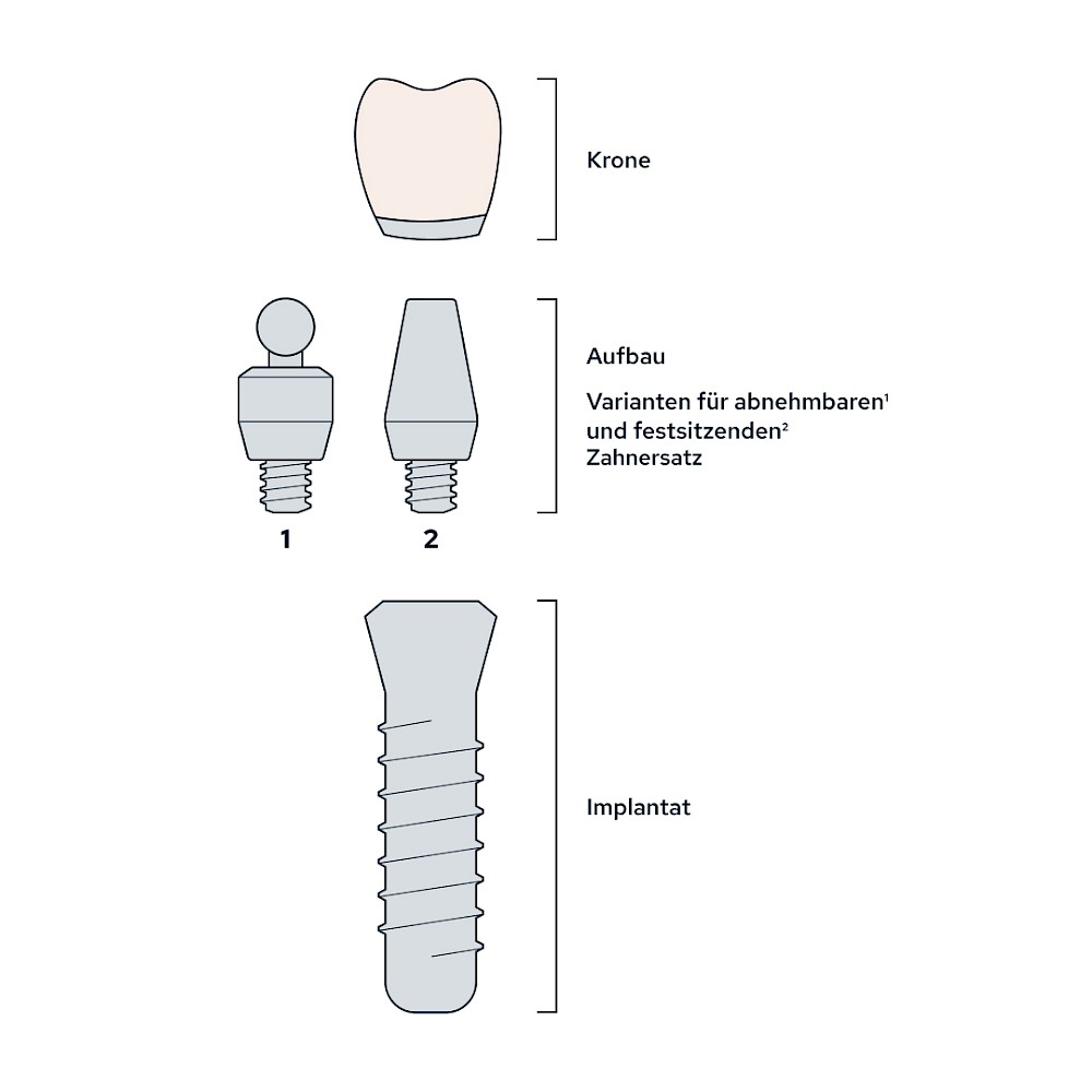 Implantat Aufbau