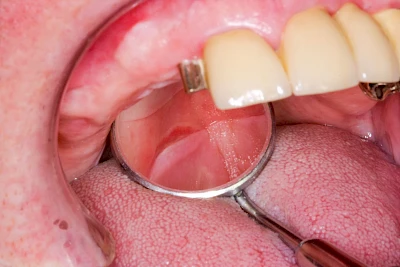 Beispiele: Druckstelle / Lappenfibrom