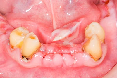 Beispiele: Druckstelle / Lappenfibrom