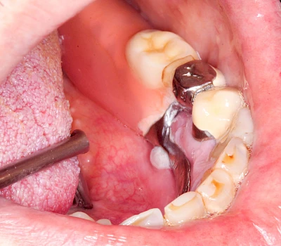 Beispiele: Druckstelle / Lappenfibrom