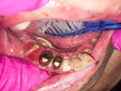 Beispiele: Druckstelle / Lappenfibrom