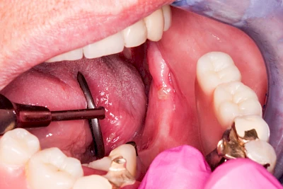 Beispiele: Druckstelle / Lappenfibrom
