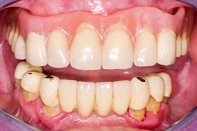 Beispiele: Prothesenstomatitis