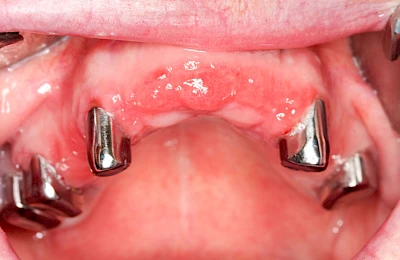 Beispiele: Prothesenstomatitis