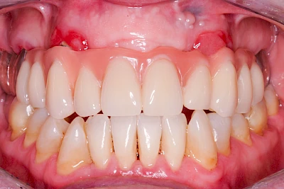 Beispiele: Prothesenstomatitis