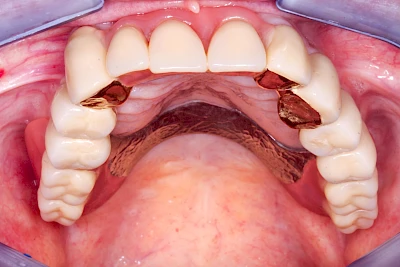 Beispiele: Prothesenstomatitis