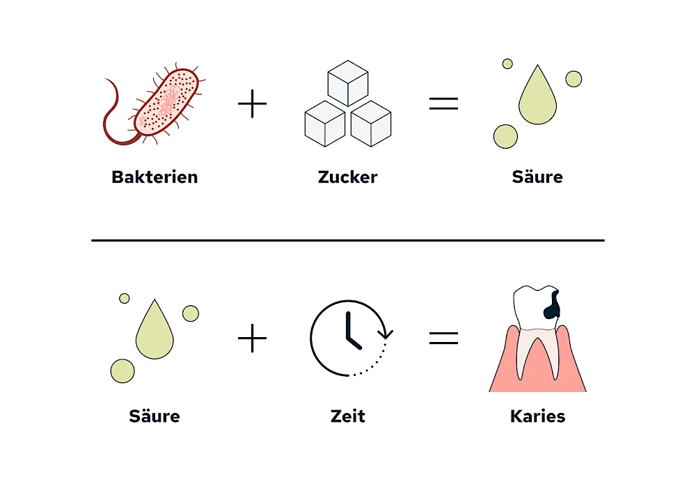 Karies: Ursachen