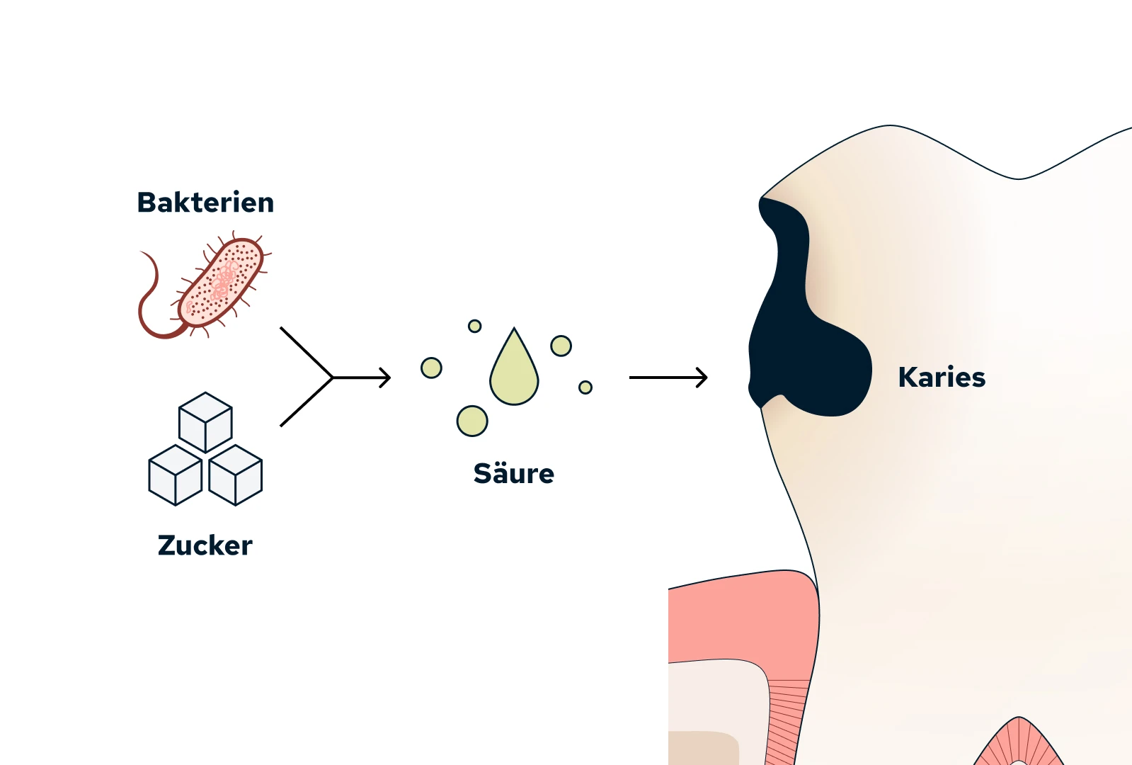 Karies: Entstehung