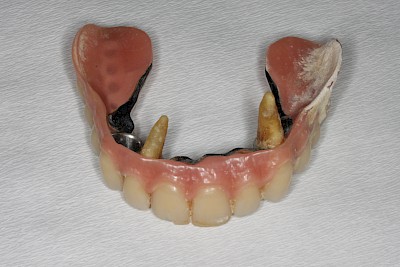 Zahnprothese Beispiele für Verlust der Verankerung an Zähne bzw. Implantaten 